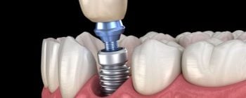 osteoporosis and dental implants