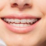 57785Night Guard for Braces: Can You Wear a Guard During Ortho Treatment?