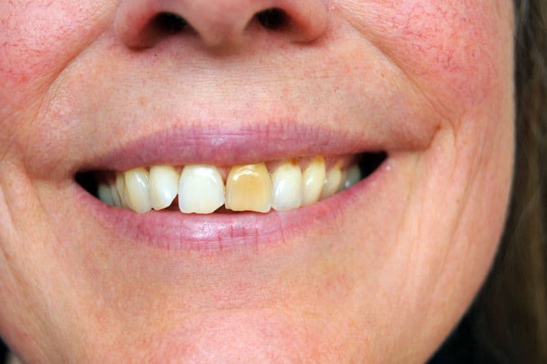 Black Stains on Teeth How To Get Rid of Black Spots on Teeth