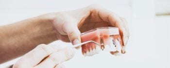 dental implant showing through gum