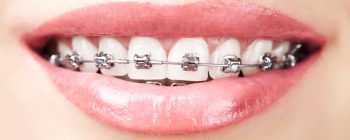 Adult Braces