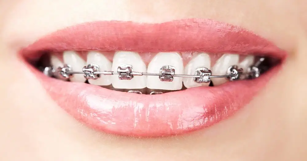 Adult Braces