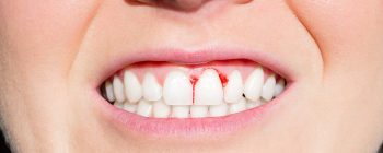 Bleeding Gums