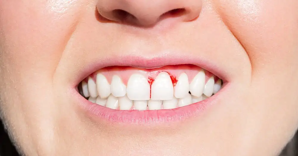 Bleeding Gums