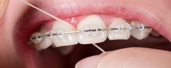Flossing with Braces