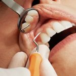 60551Sinus Lift Surgery for Teeth Implants: Procedure, Costs, and More