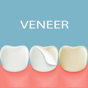 are dental veneers covered by insurance