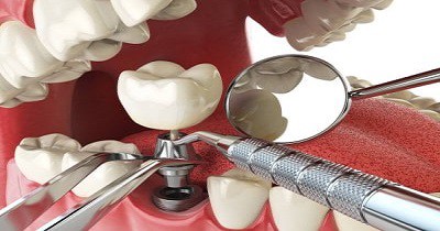 Cheap Dental Implants
