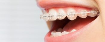 Clear Braces