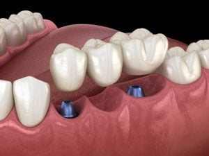 dental implants multiple teeth
