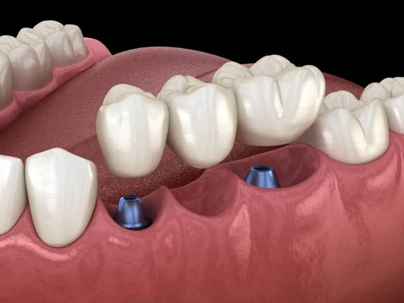 1 Dental Implant for 2 Teeth Benefits and Costs 2024