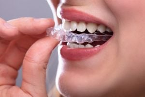 how to keep aligners clean