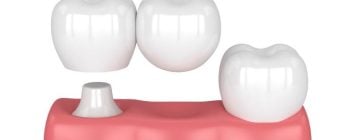 1 dental implant for 2 teeth