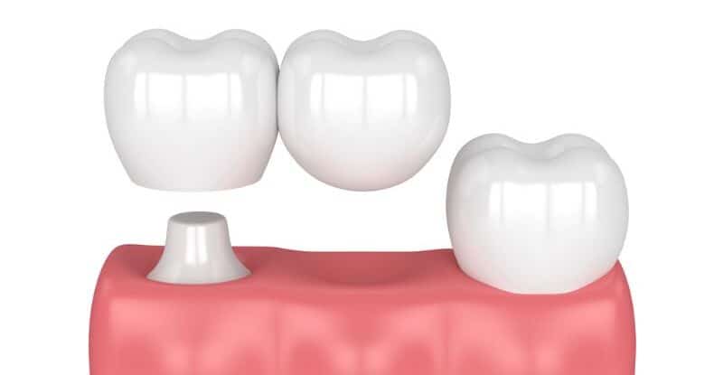1 dental implant for 2 teeth