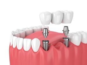 2 tooth implant