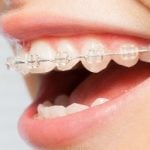 delta dental orthodontic coverage