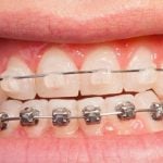 64156Sensitive Teeth After Whitening: What to Do to Relieve Your Pain