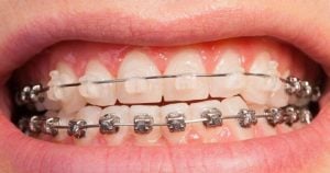 braces bottom teeth only