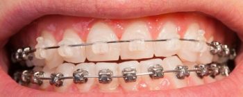 does delta dental cover braces