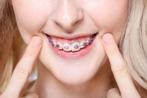 delta dental coverage for braces