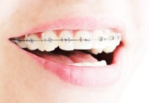 delta dental braces cost