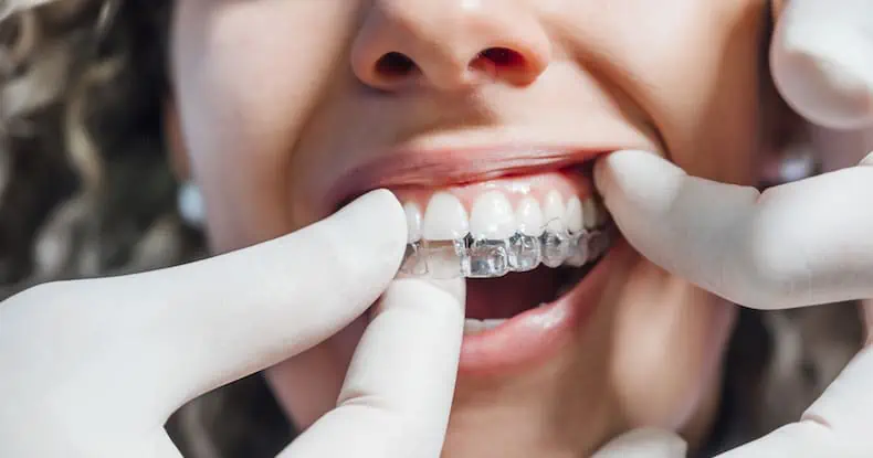 how much does invisalign cost