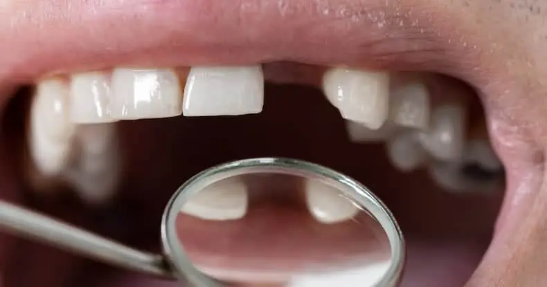 Close-up of an open mouth showing teeth, with a dental mirror reflecting a tooth.
