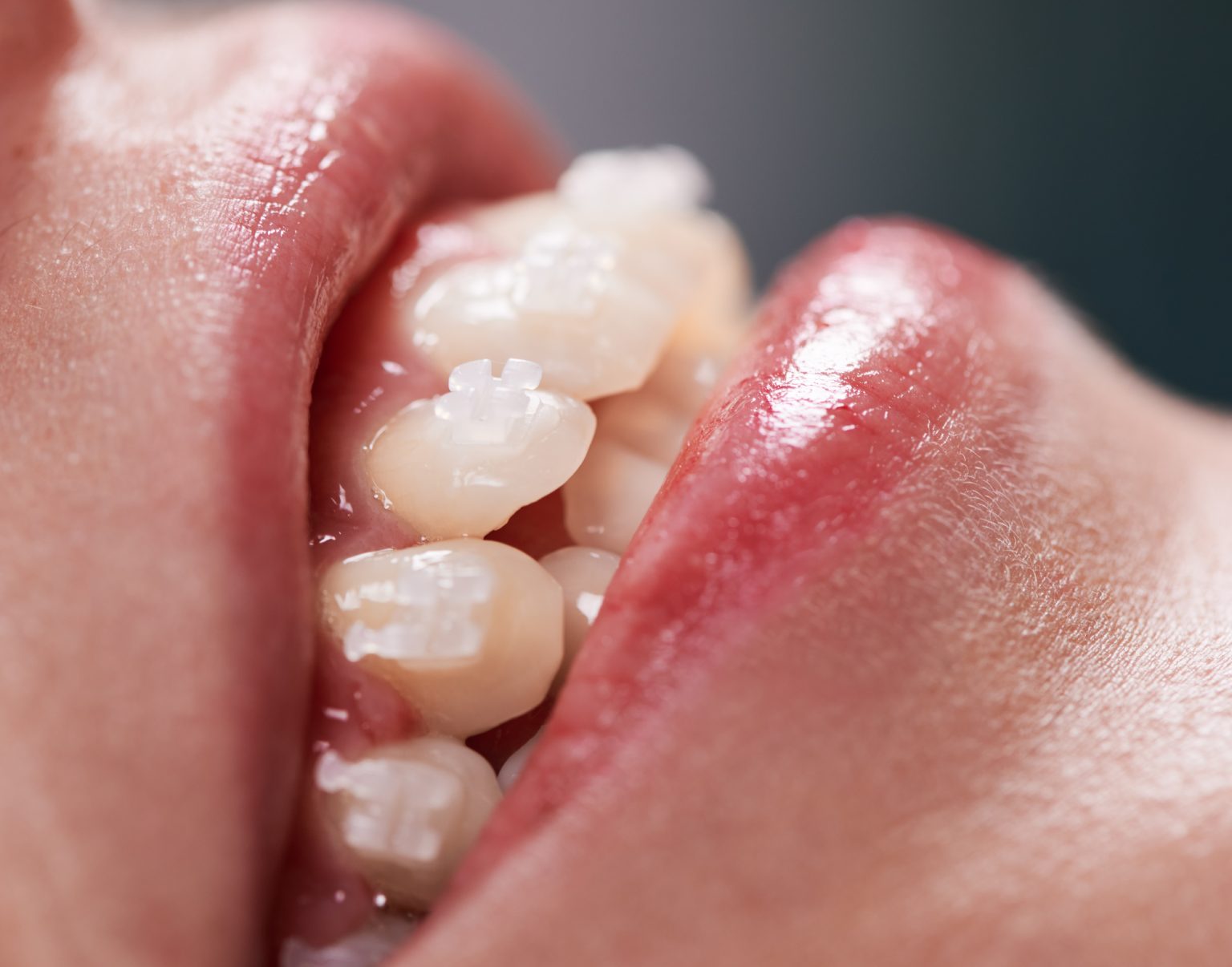 Top Braces Only for Minor Straightening Cost, Risks, and Benefits