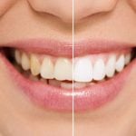 70206Teeth Hurt After Wearing a Night Guard: Reasons and Solutions