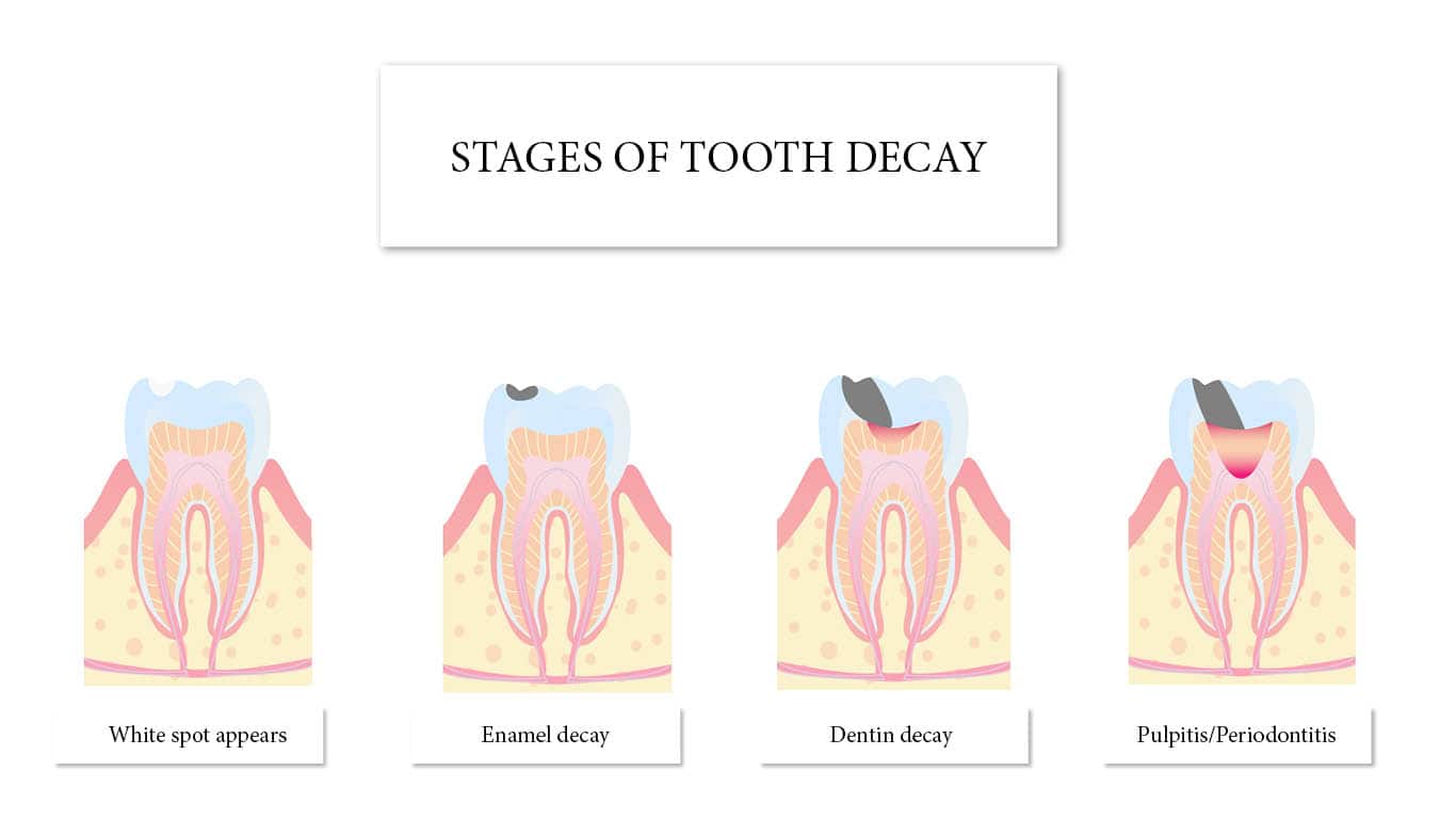 What Does a Cavity Look Like in Different Stages and Teeth?