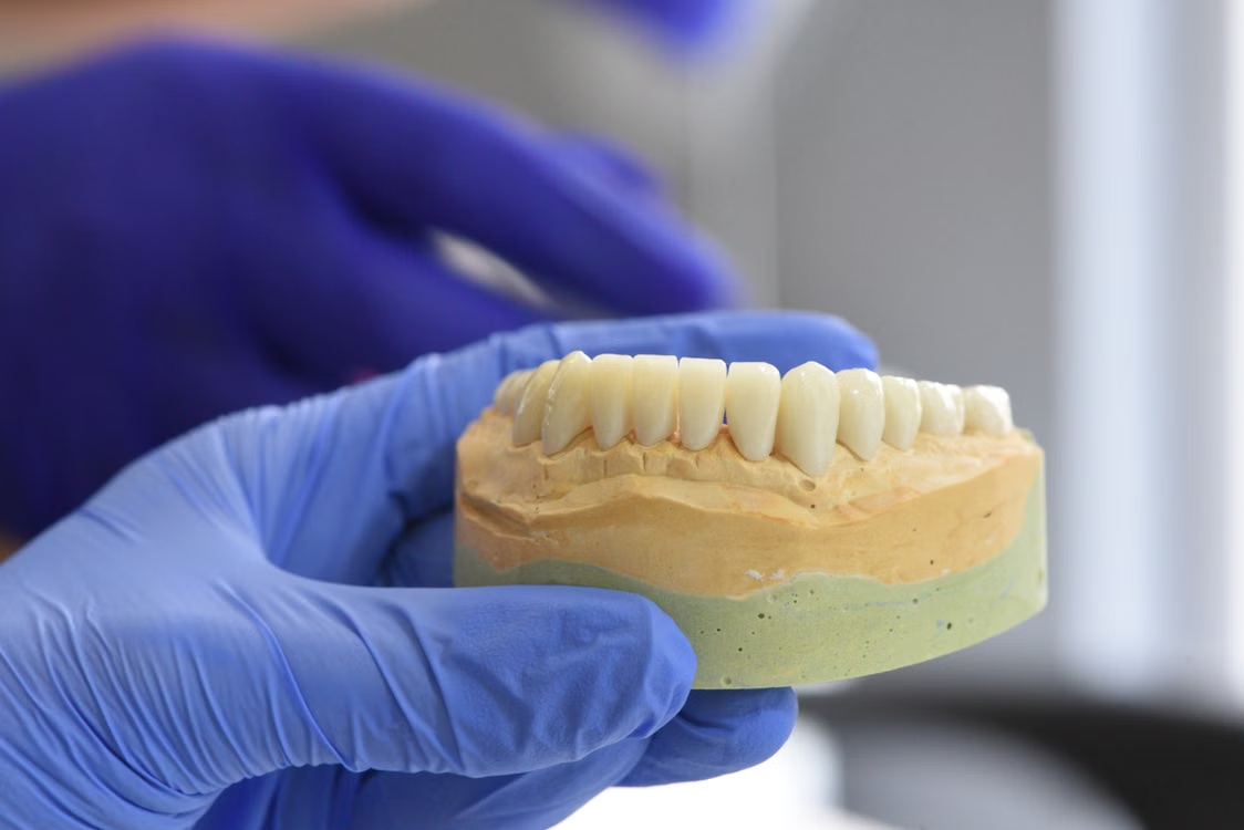 Gloved hand holding a dental bridge model on a stone cast