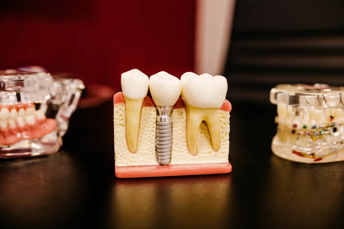Dental model showing an implant between two teeth