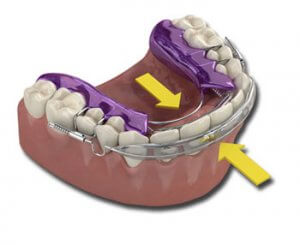 inman clear aligner