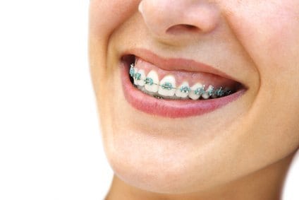 De belles bagues en métal pour un joli sourire