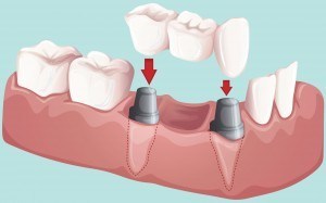 Bridge dentaire pour refaire des dents.