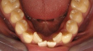 appareil dentaire adulte après encombrement dentaire