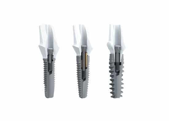 implant pilier et dent