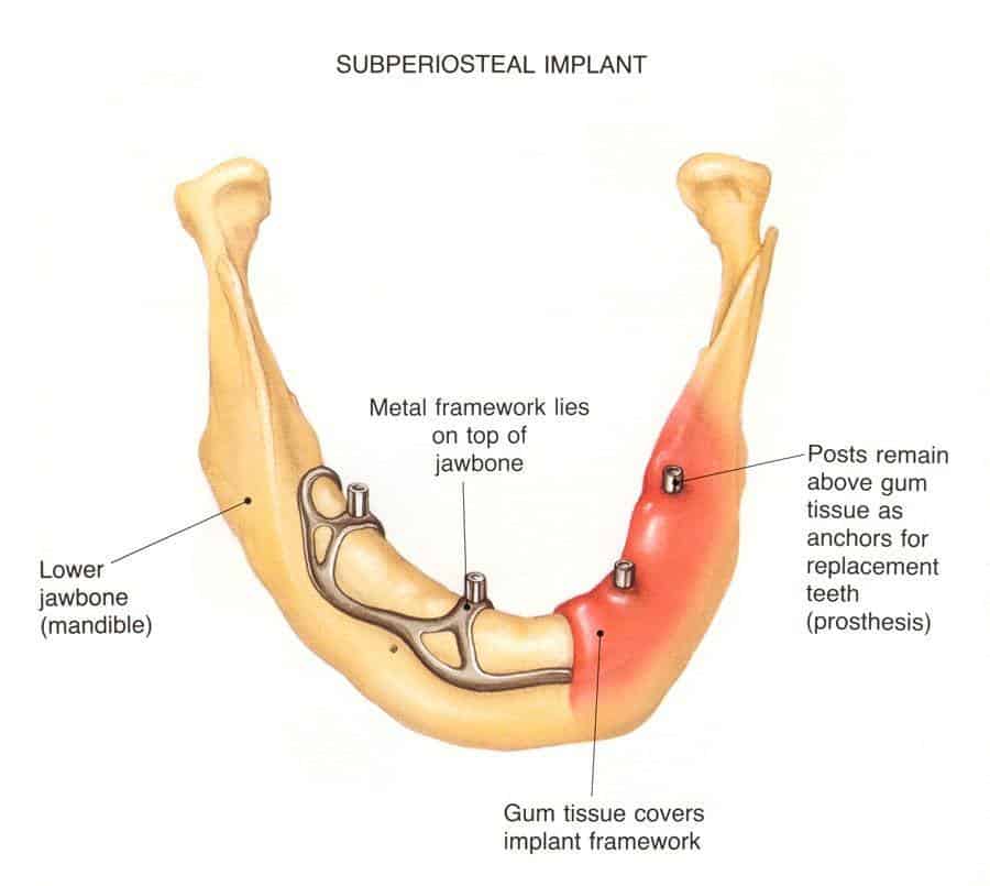 implant subperiosteral