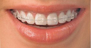 sourire appareil dentaire