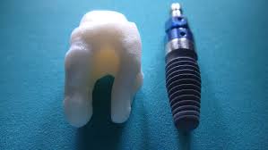 implants dentaires en hongrie