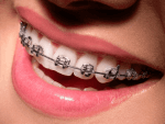 40623La brosse à dents électrique Foreo ISSA mini : avis de la rédaction