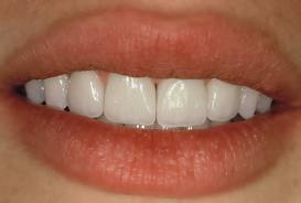 nouvelles dents