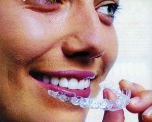 laver appareil dentaire