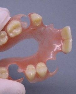 Le dentier sans palais