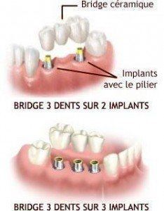 bridge trois dents, trois implants ou deux implants