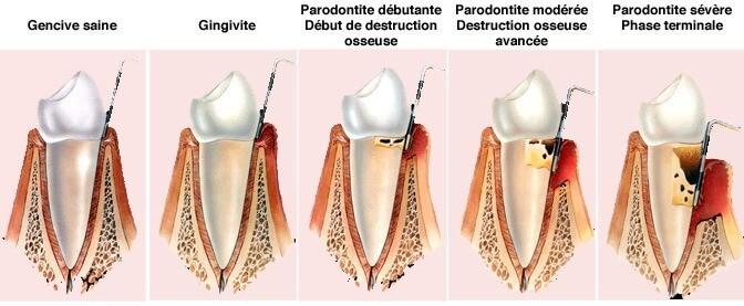 La parodontite