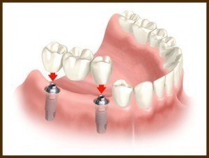 Bridge sur implant