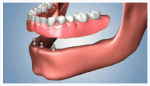 Dentier fixe sur implant