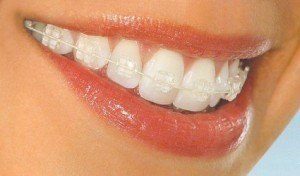 Bagues transparentes