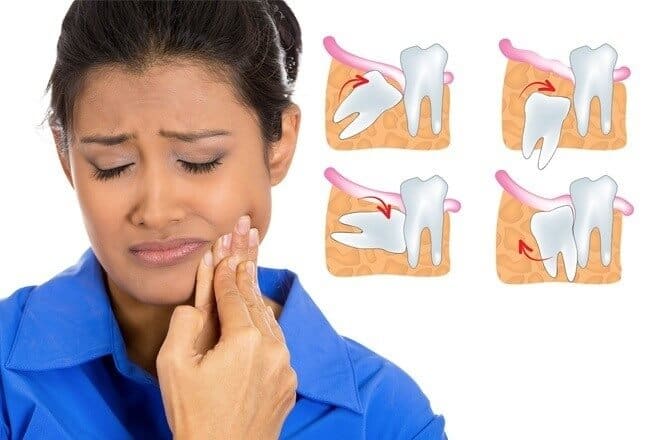 Dents de sagesse : prix et déroulement de l'extraction